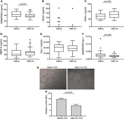 Tocilizumab (TCZ) Decreases Angiogenesis in Rheumatoid Arthritis Through Its Regulatory Effect on miR-146a-5p and EMMPRIN/CD147